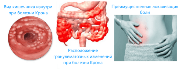 Болезнь Крона