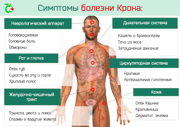 Симптомы болезни Крона и воспаления кишечника
