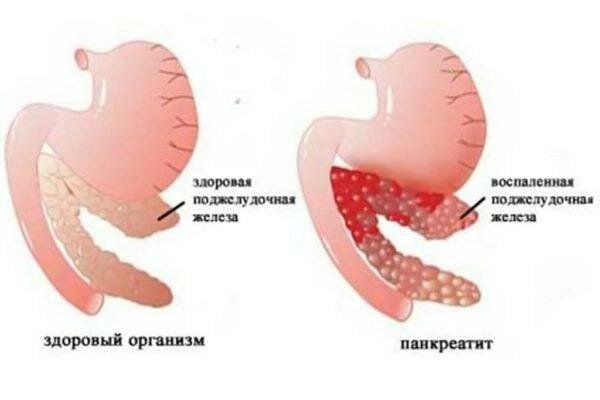 Воспаление поджелудочной железы при панкреатите